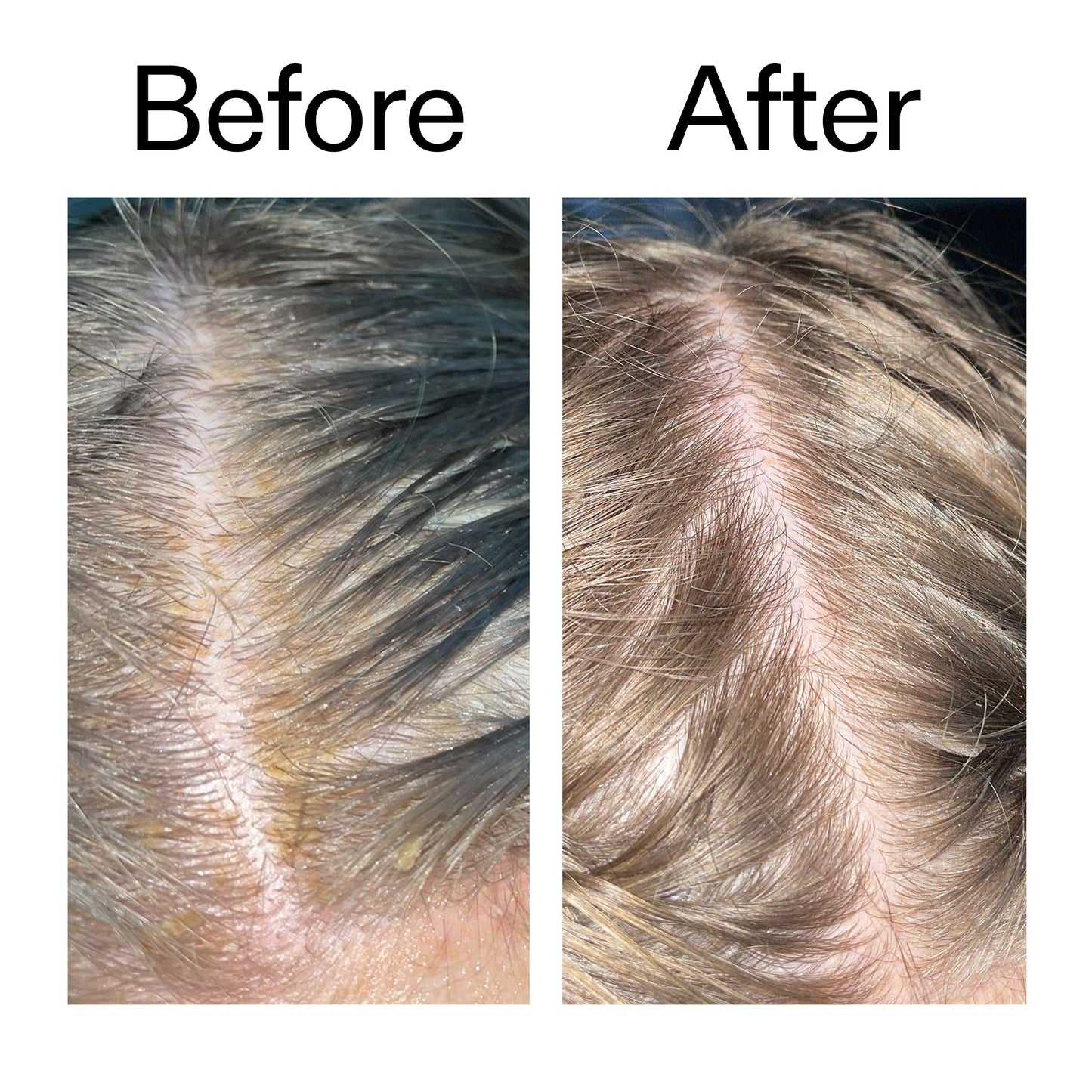salicylic-acid-exfoliating-scalp-treatment-a9 Salicylic_Acid_Exfoliating_Scalp_Treatment_Before_After_2000x2000_e572a30f-057c-4a48-823b-1c09dc97f8d0.jpg