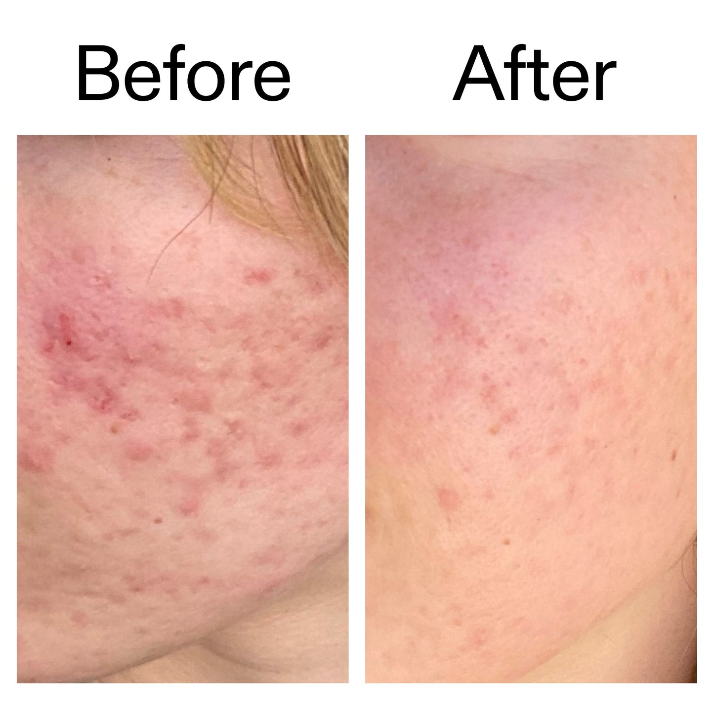10-azelaic-acid-serum-for-redness-relief-m0 Azealic_Acid_Serum_B_A_Ppage_2000_x_2000.jpg