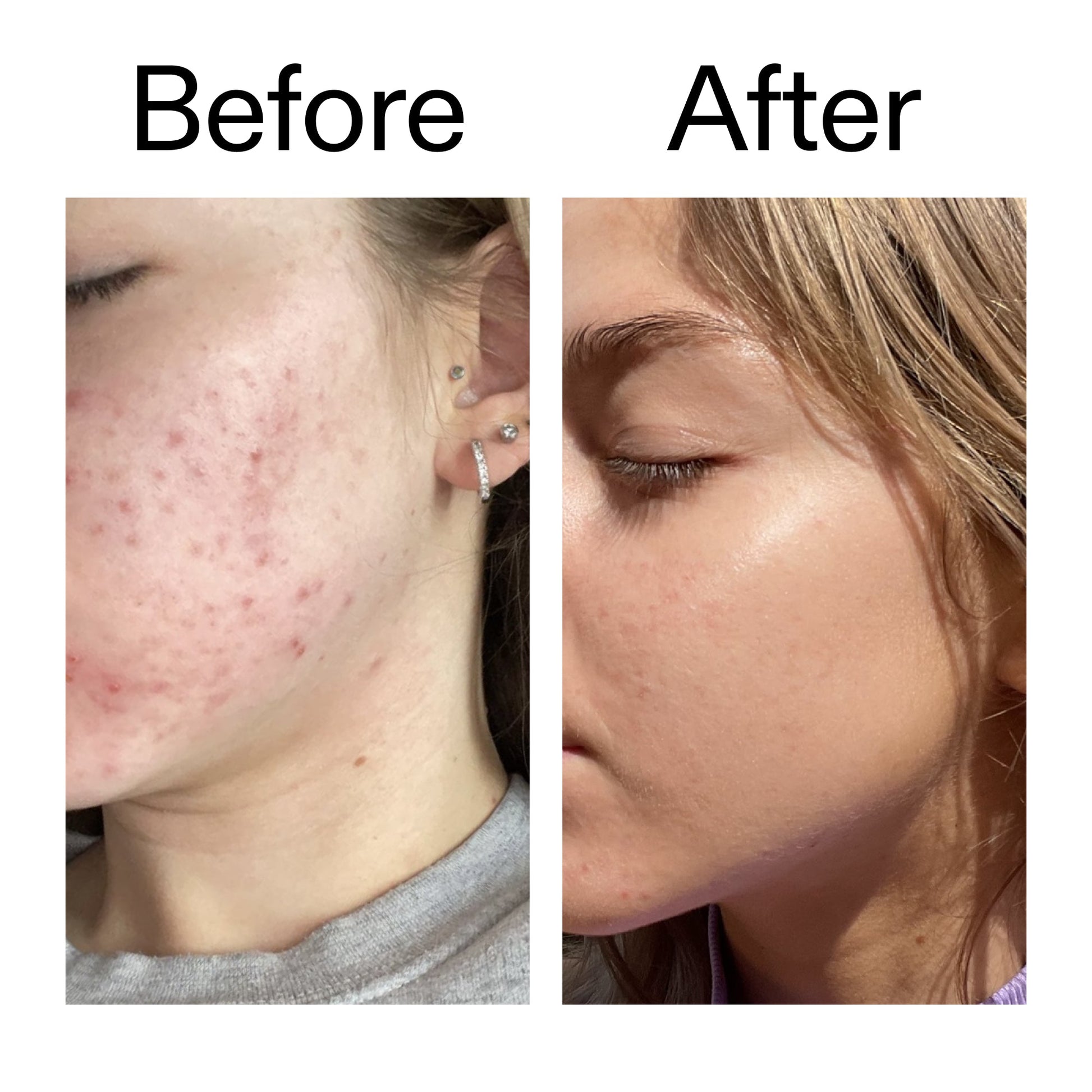 beta-hydroxy-acid-bha-serum-s3 Beta_Hydroxy_Acid_Serum_Before_After_2000x2000_96fda3e5-938d-49ef-bcf2-a0fa6ece4e2c.jpg