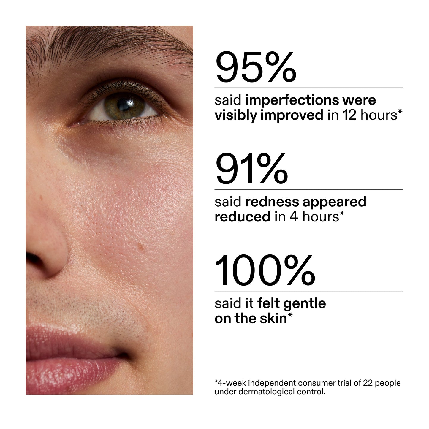 succinic-acid-acne-treatment-z5 CA_Succinic_Acid_Treatment_key_Claims_2000x2000_db91b0f1-7f29-4bfe-bb16-63a47f500960.jpg