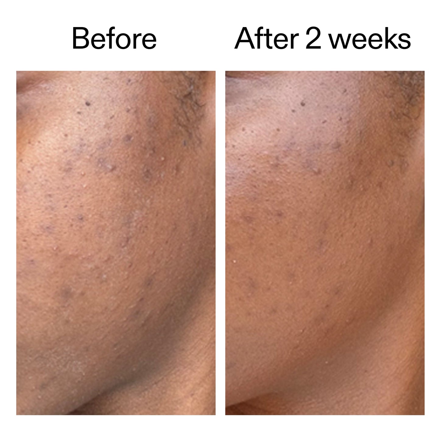 360-acne-clearing-duo-g3 DIOICB_A2000x2000.jpg