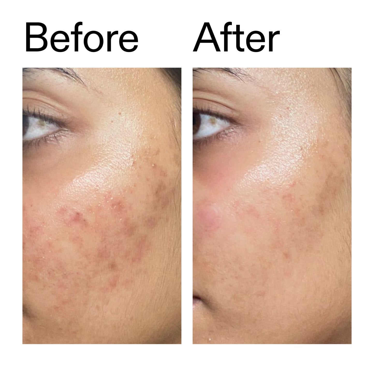 ectoin-hydro-barrier-serum-duo-g2 Ectoin_Hydro-barrier_Serum__Before_After_2000x2000_34261920-d004-48d0-9c7b-8e1c15971bfd.jpg