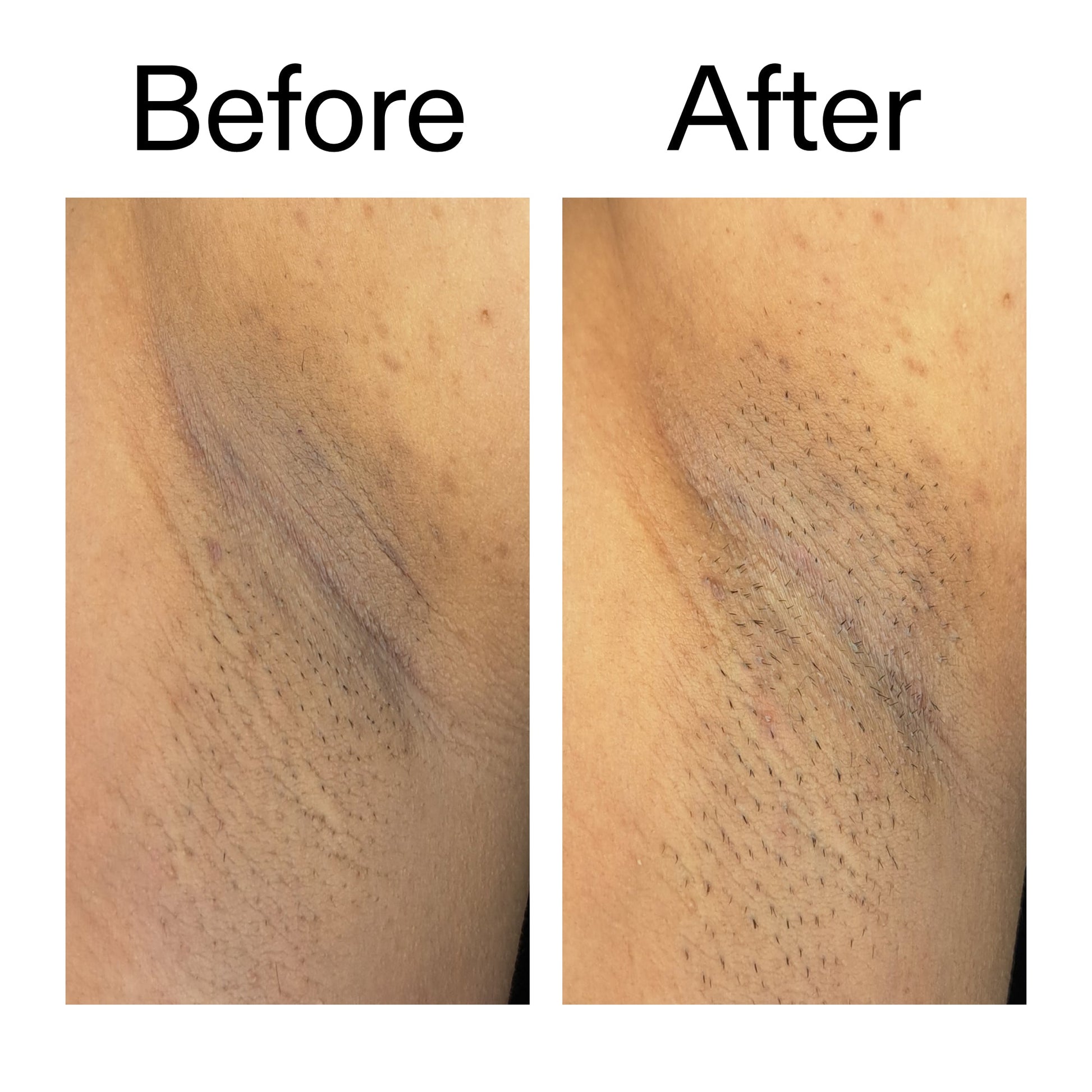 glycolic-acid-exfoliating-body-stick-duo-r4 Glycolic_Acid_Exfoliating_Body_Stick_Before_After_V3_2000x2000_ea919cd9-1439-4a46-82a0-76200eb5bb42.jpg