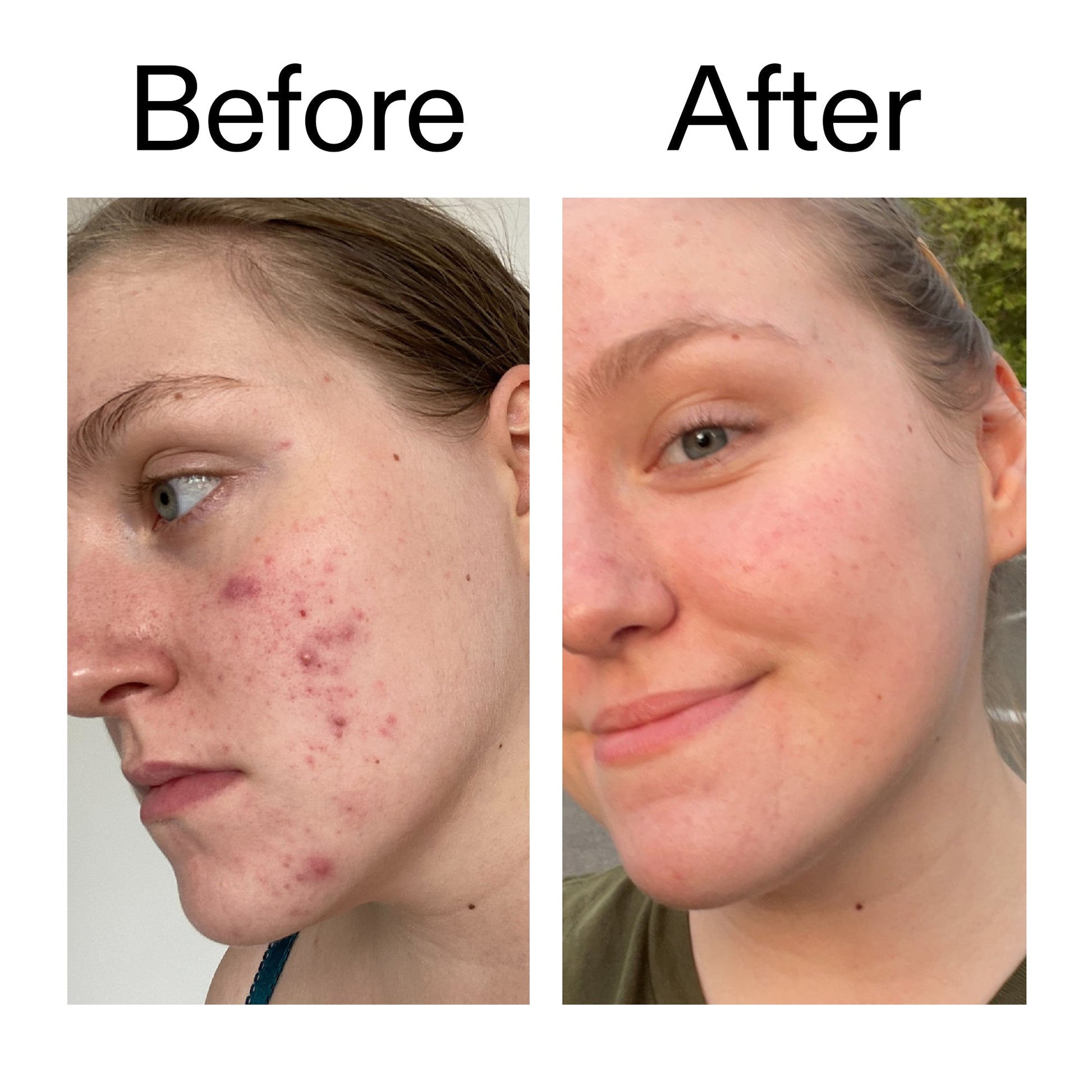 glycolic-acid-toner-x1 Glycolic_Acid_Toner_Before_After_2000x2000_49f0b9f7-e71b-4b2e-a8f8-2ea4b73247bb.jpg