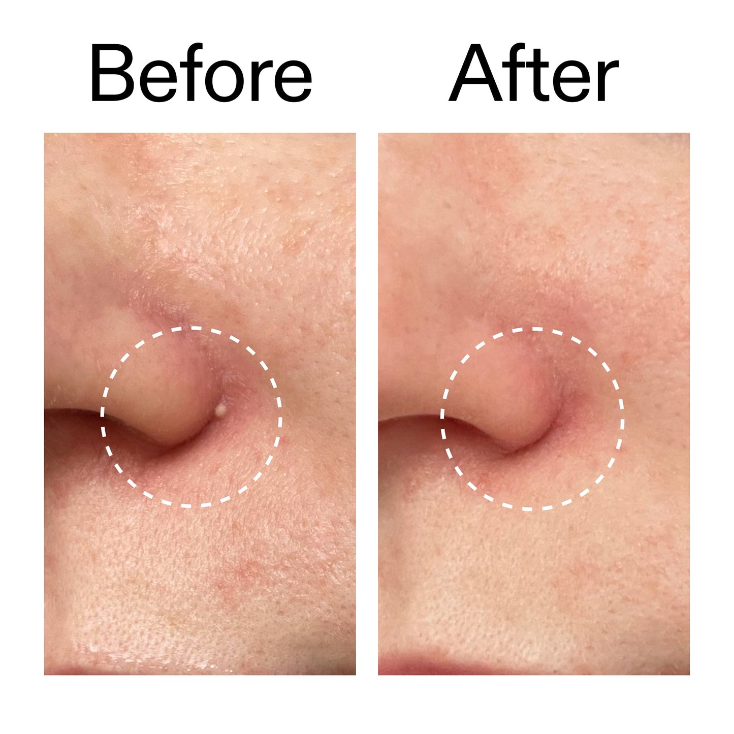 hydrocolloid-invisible-pimple-patches-pack-of-22-j1 Hydrocolloid_Invisible_Pimple_Patches_Before_After_2000x2000_b02aa37b-c78a-4682-91de-9135af5bb7df.jpg