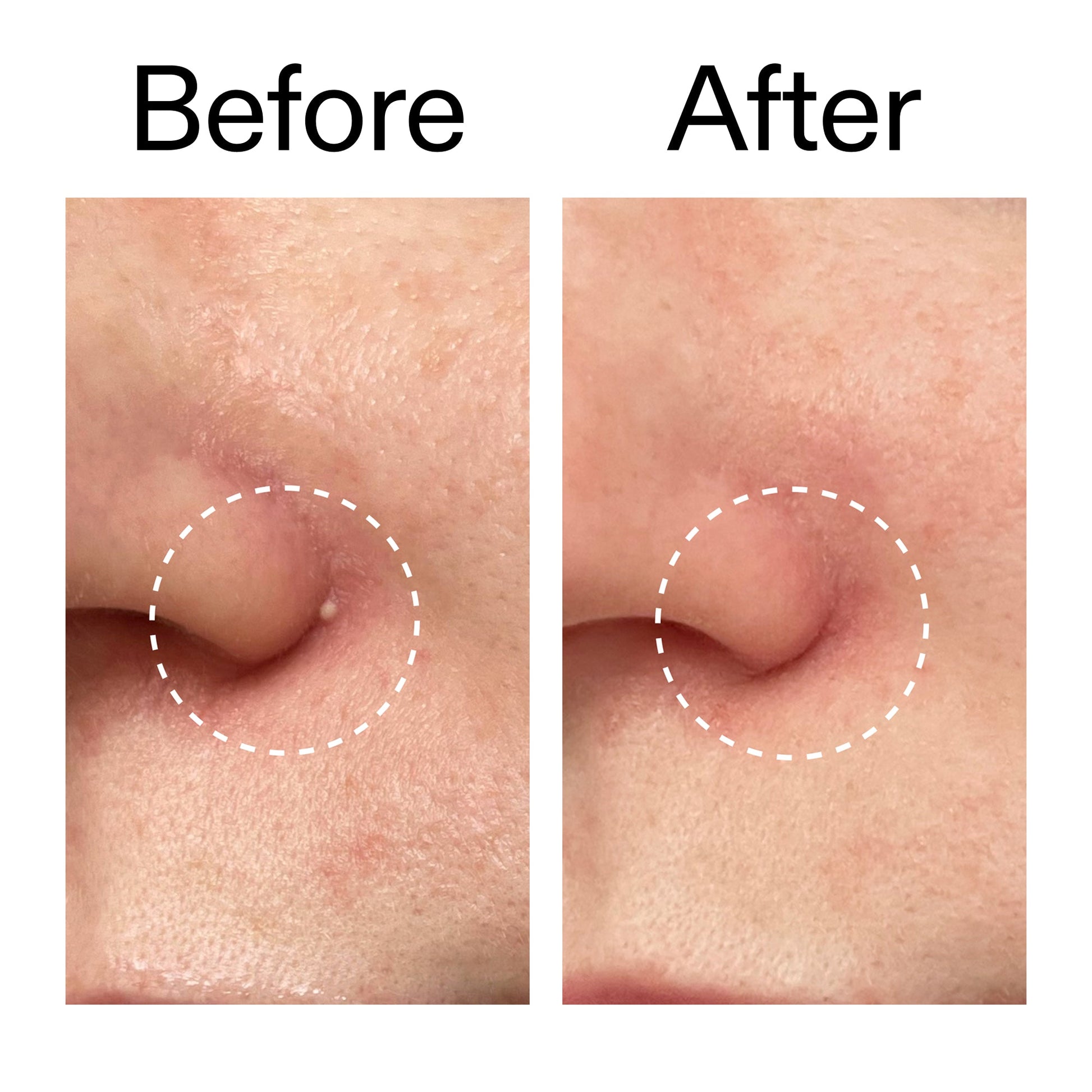 hydrocolloid-invisible-pimple-patches-pack-of-22-j1 Hydrocolloid_Invisible_Pimple_Patches_Before_After_2000x2000_b02aa37b-c78a-4682-91de-9135af5bb7df.jpg