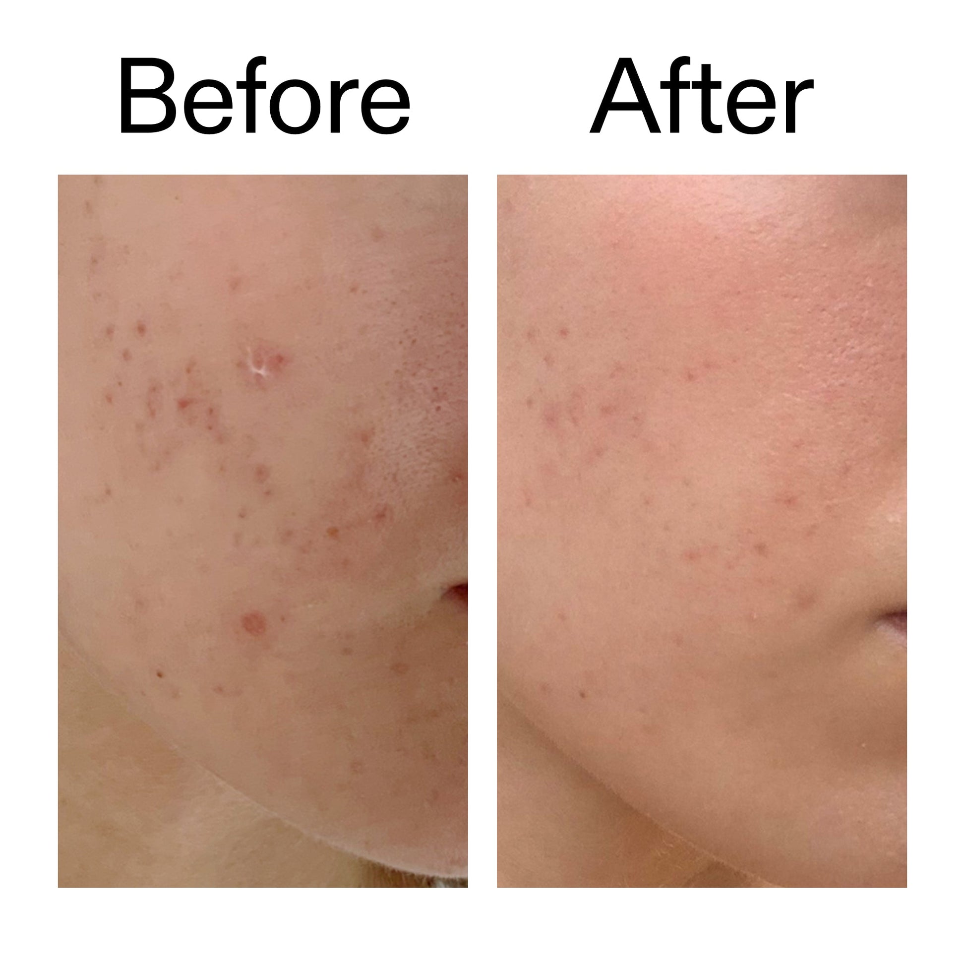 mandelic-acid-treatment-l3 Mandelic_Acid_Treatment_Before_After_2000x2000_4885ac6e-c5d7-4279-a72a-1417af7dce35.jpg