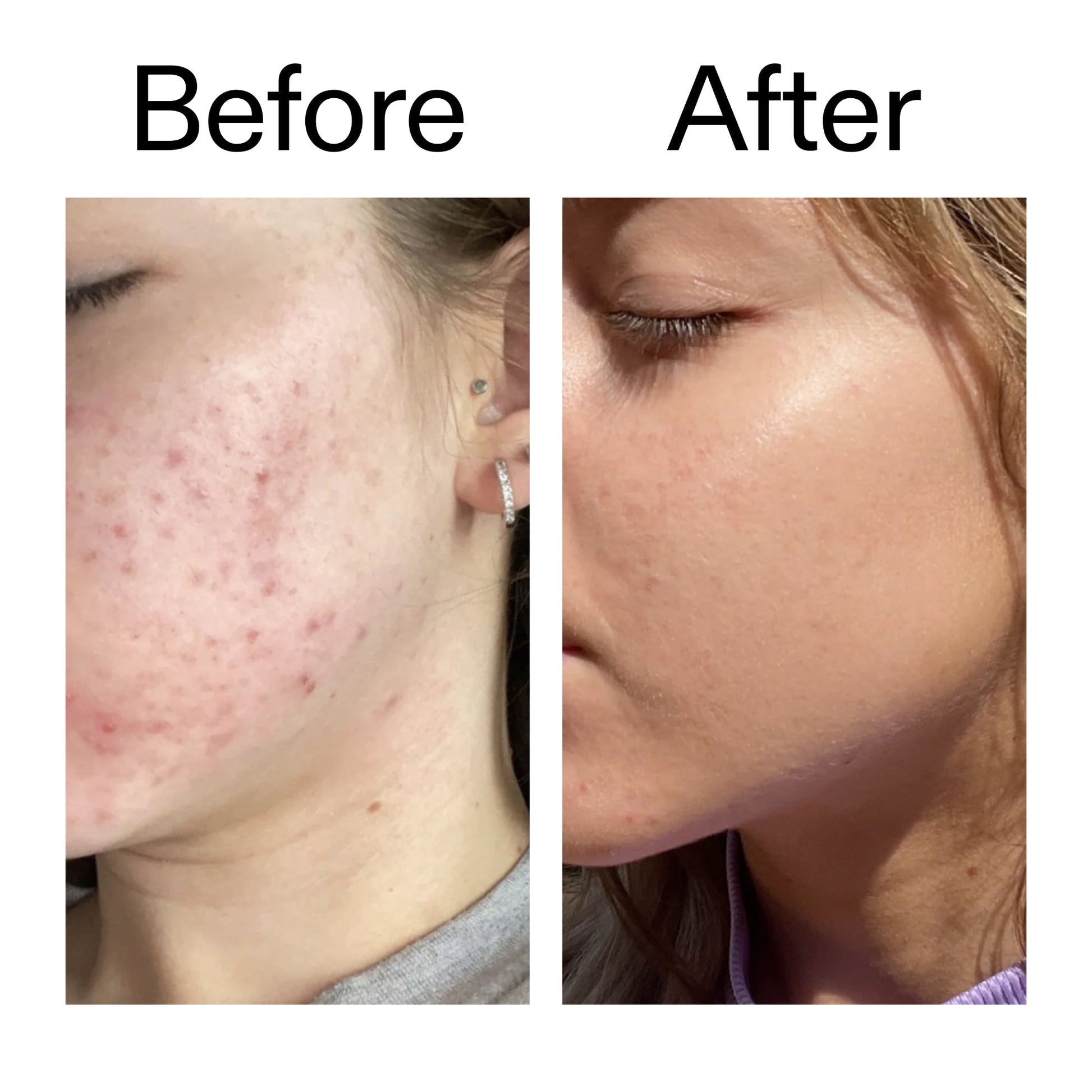 10-niacinamide-serum-duo-g2 Niacinamide_Serum_Before_After_2000x2000_bde32455-9e7d-448e-b053-bef41504f0a9.jpg
