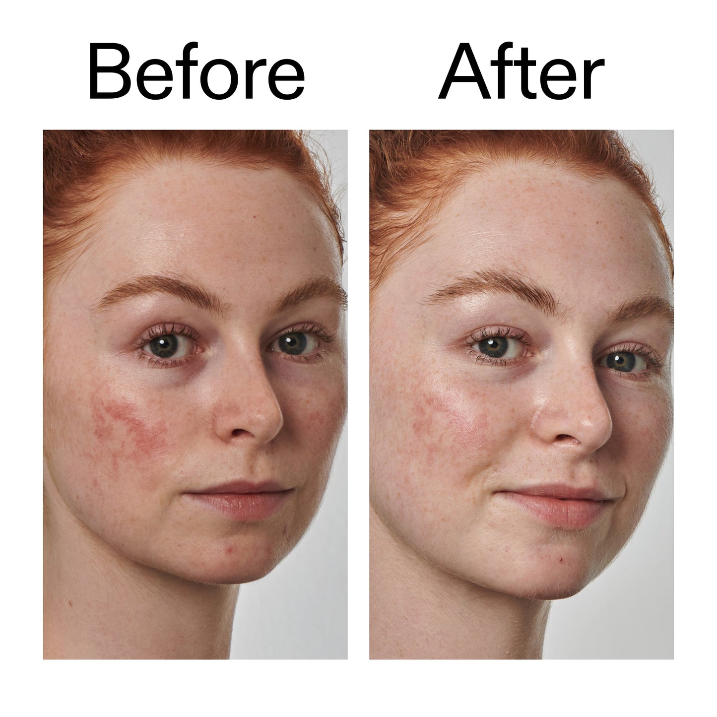 10-azelaic-acid-serum-for-redness-relief-m0 Redness_Relief_Serum_Before_After_2000x2000_3334dc9a-cce9-4e00-8aec-7ad89ca051f2.jpg