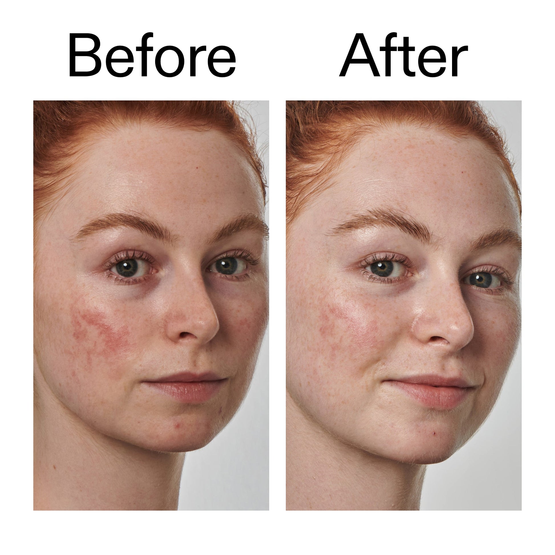 10-azelaic-acid-serum-for-redness-relief-m0 Redness_Relief_Serum_Before_After_2000x2000_3334dc9a-cce9-4e00-8aec-7ad89ca051f2.jpg