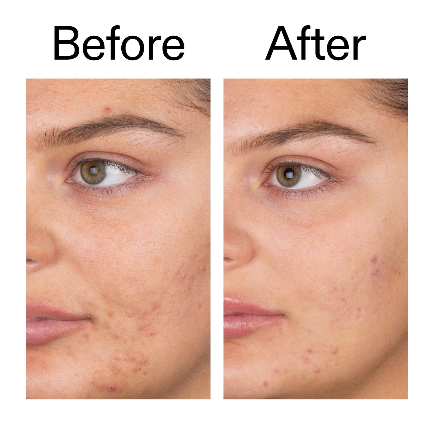 salicylic-acid-cleanser-150ml-c6 Salicylic_Acid_Cleanser_-_150ml_Before_After_2000x2000_e7230494-853f-4b07-82b1-27669104c995.jpg