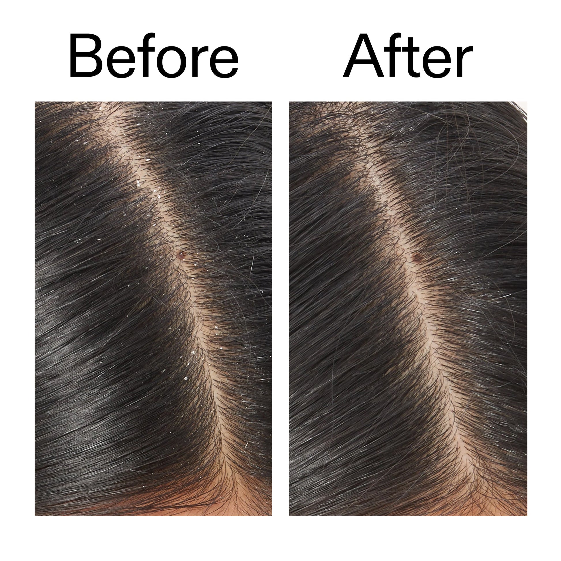 salicylic-acid-exfoliating-scalp-treatment-a9 Salicylic_Acid_Exfoliating_Scalp_Treatment_Before_After_V2_2000x2000_02bd61ad-42bf-490b-b3e3-7e04b2e8a673.jpg