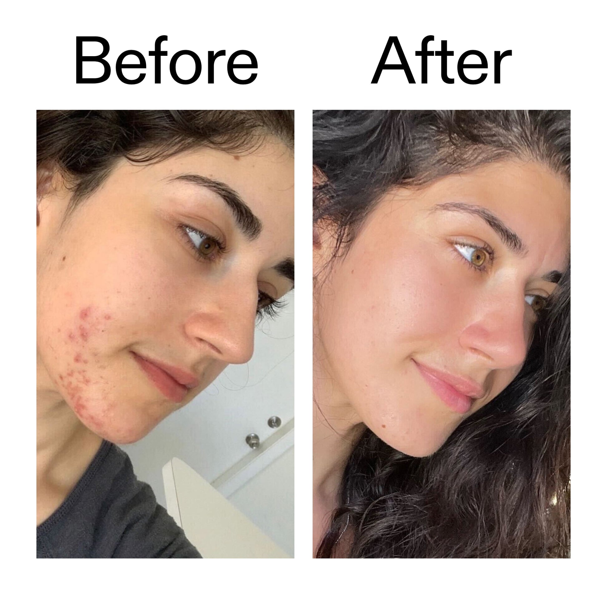 succinic-acid-acne-treatment-z5 Succinic_Acid_Treatment_Before_After_2000x2000_6a5f0054-2f58-4433-9314-0dc72c9bdd3b.jpg