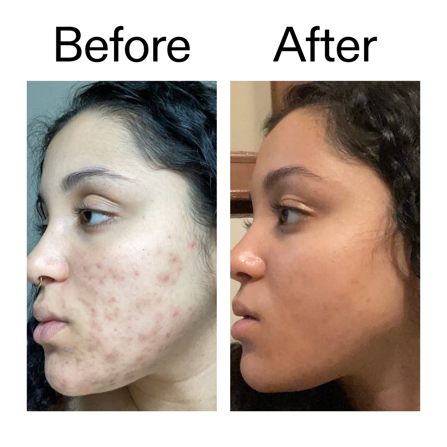 tranexamic-acid-serum-z0 Tranexamic_Acid_Serum_Before_After_2000x2000_98ebc8be-77b0-4843-8a22-90790ebe918b.jpg
